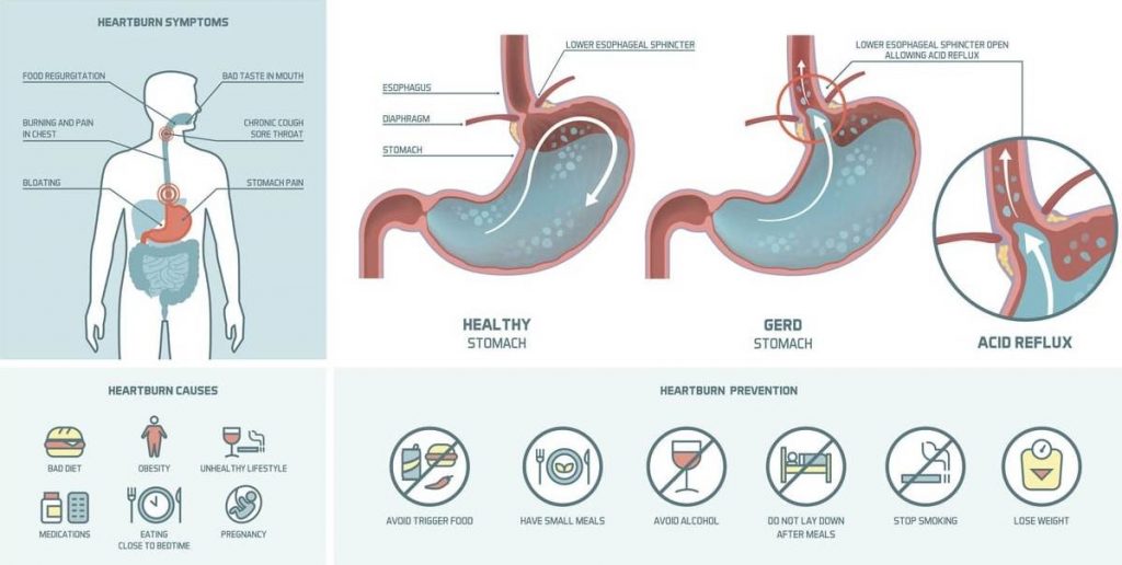 GASTROESOPHAGEAL REFLUX DISEASE (GERD) - BIMS Hospital