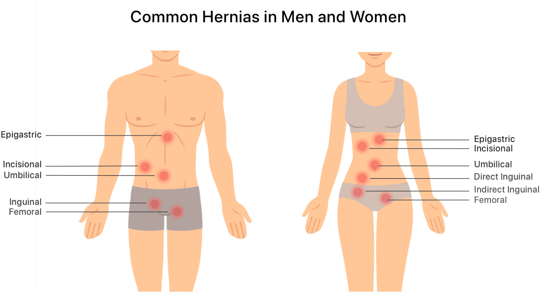 What Are The Types of Abdominal Hernias & How Do You Treat Them